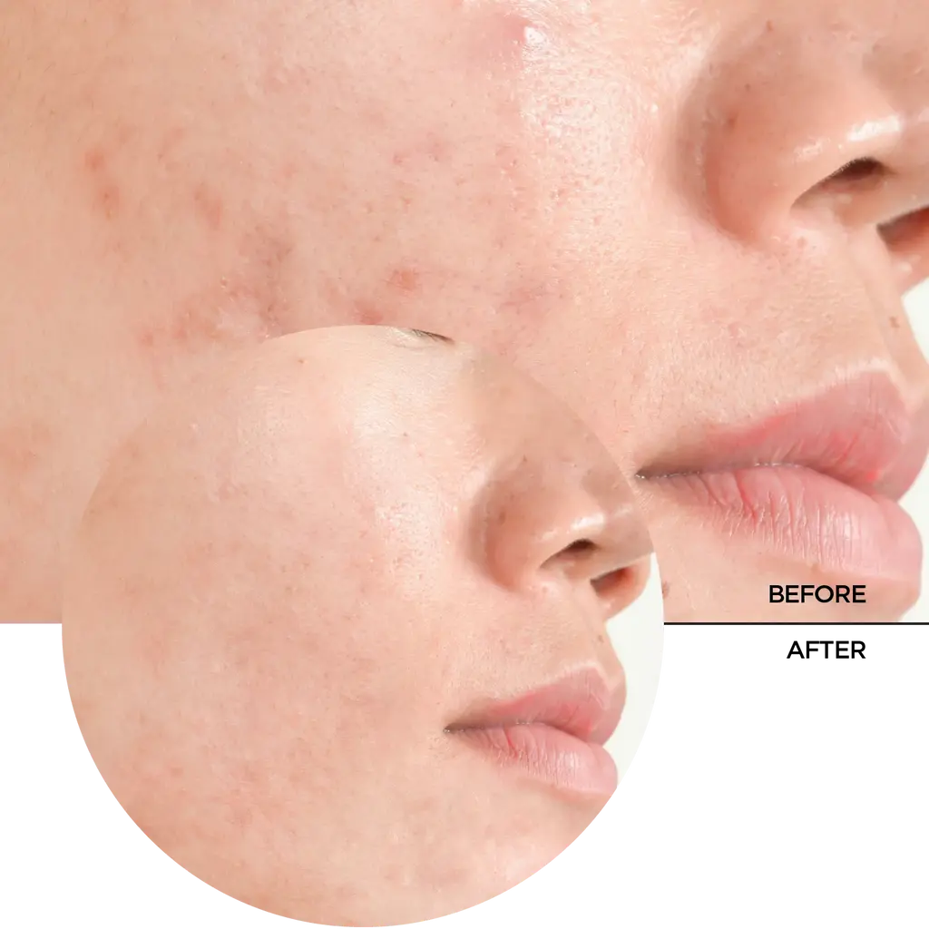 REVOX Just Salicylic Acid 2%  Peeling Solution - 30ml6.webp
